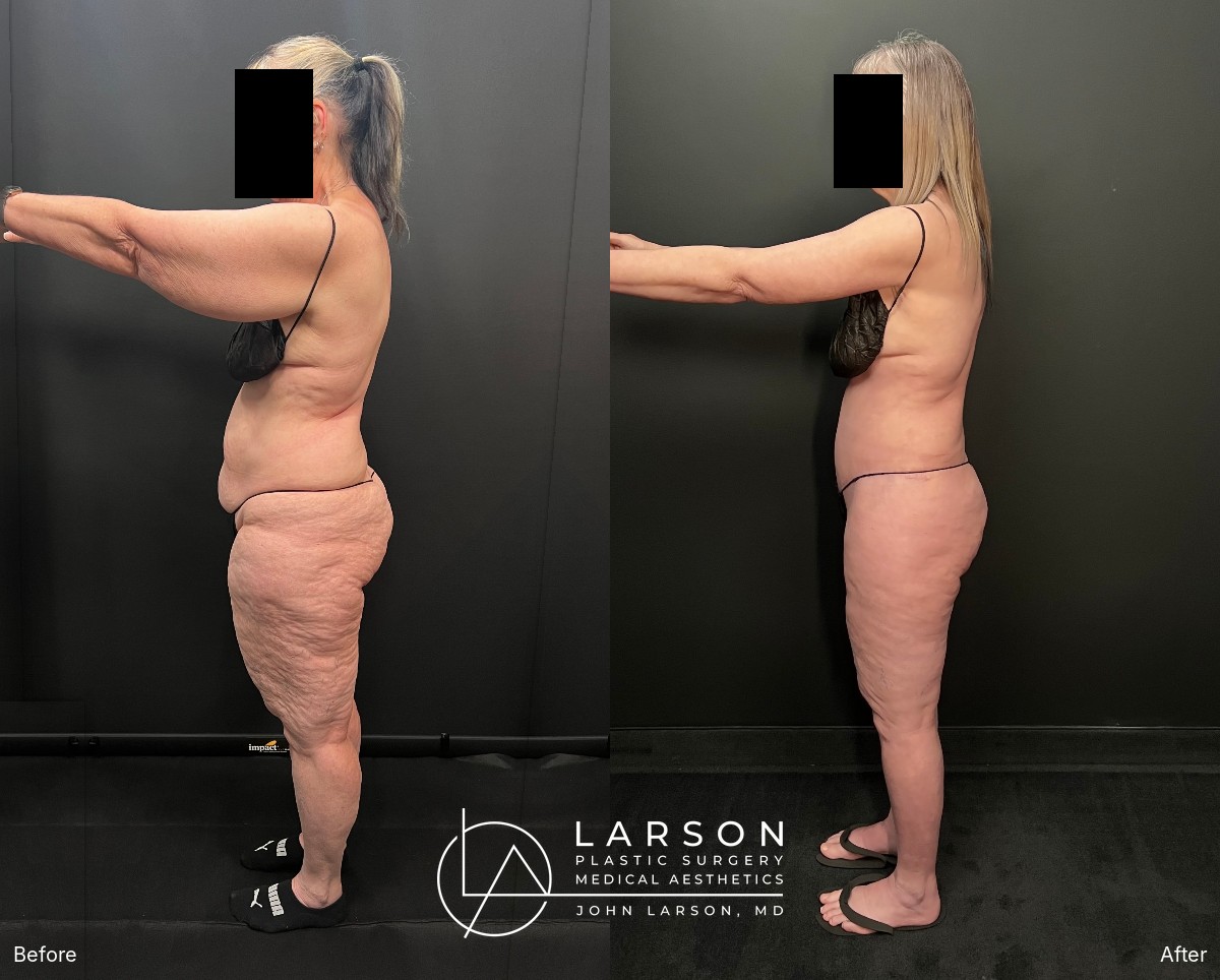 Left side view with arms forward, before and after lipedema surgery of the arms, abdomen and legs
