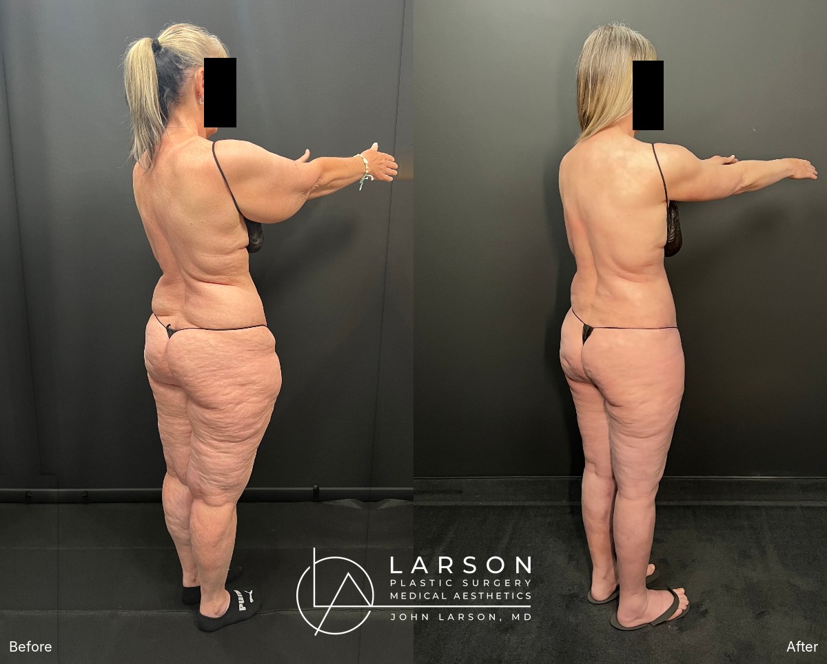 Back right oblique view, before and after lipedema liposuction of the hips, buttocks and legs