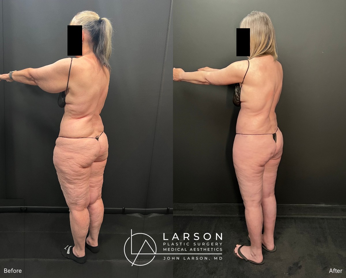 Back left oblique view, before and after lipedema liposuction with hip and thigh lift