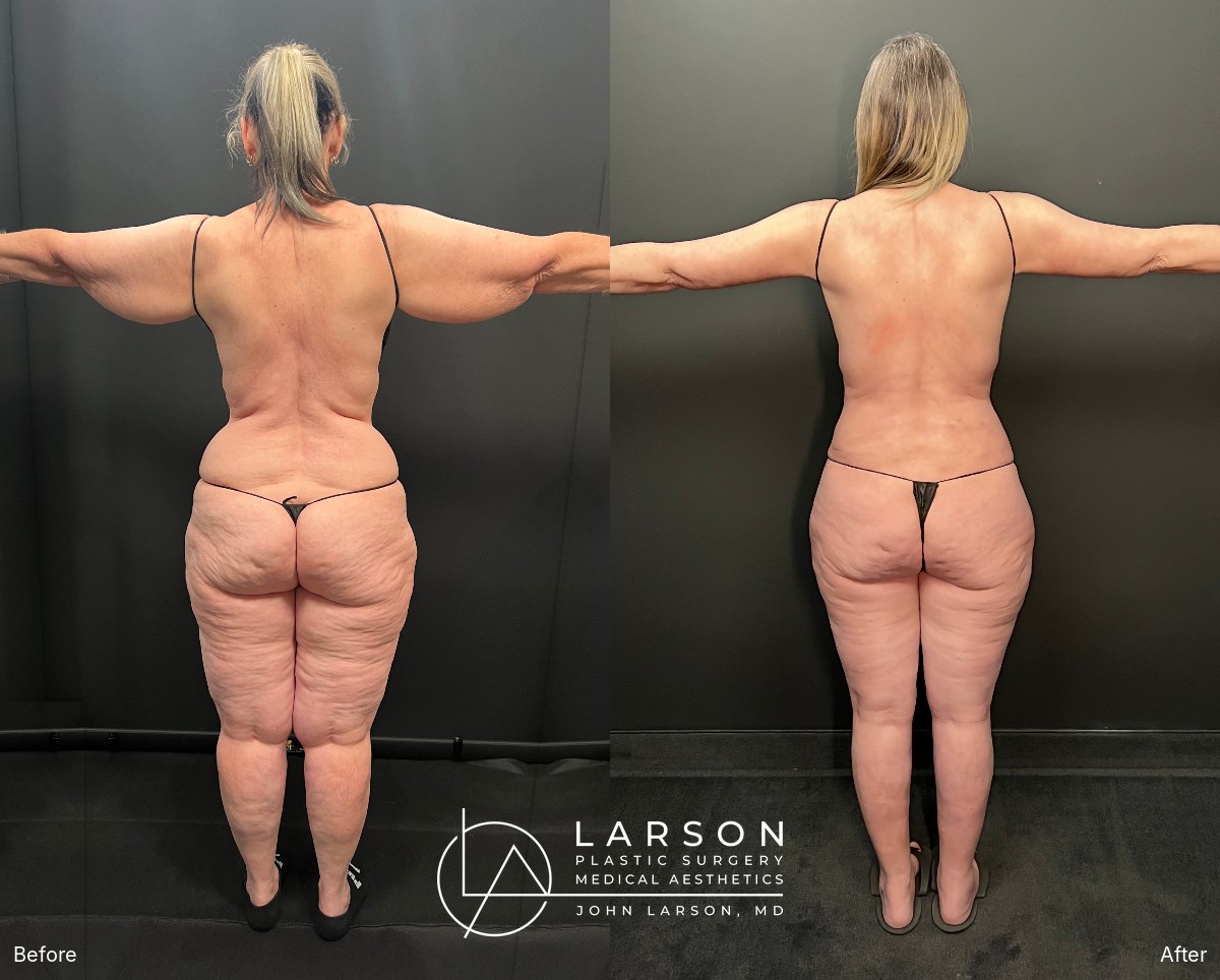 Back view with arms flexed, before and after lipedema arm liposuction and brachioplasty